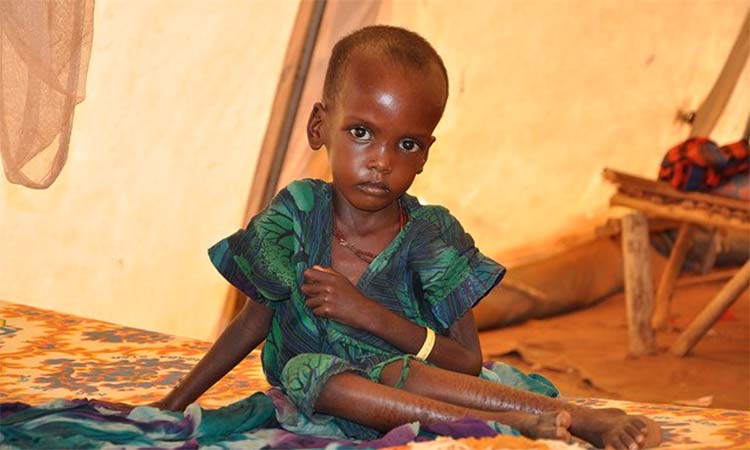  Malnourishment a crippling problem in Africa